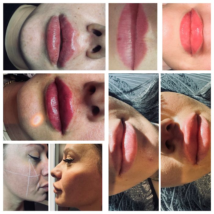 Modelowanie ust wolumetria i inne zabiegi