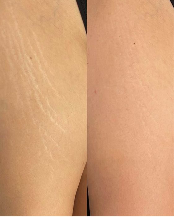 Мікроліндінг-Видалення шрамів-Рубці-Розтяжки