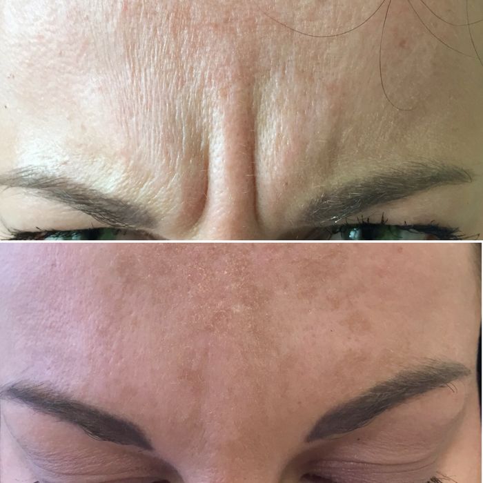 Губи та Ботокс  Новорічні знижки !!!