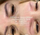 Лазерное удаление татуажа