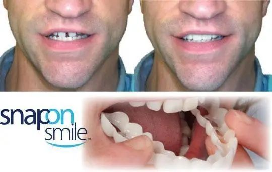 Виниры SnapOn Smile Veneers для верхних и нижних зубов снеп он смайл