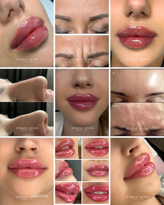 Powiekszanie ust, powiększanie, modelowanie ust