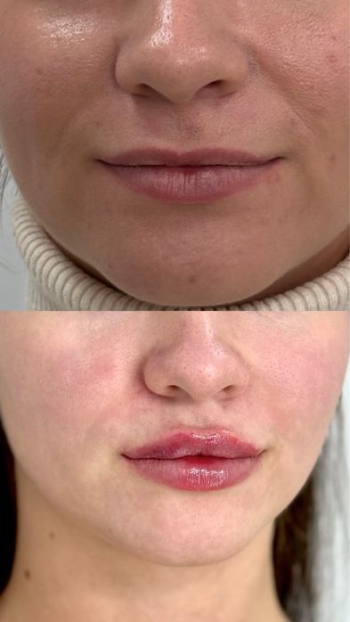 Шукаю моделей на контурну пластику губ,препарати тільки сертифіковані