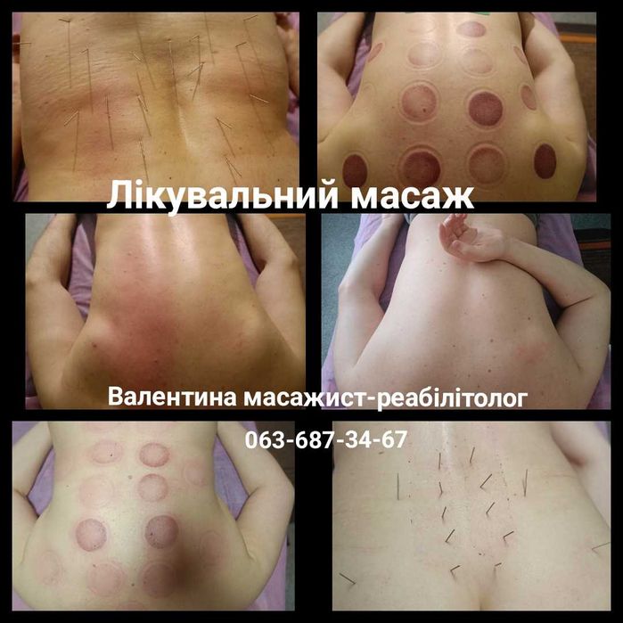 Массаж предстательной железы. Реабилитация, лечебный массаж