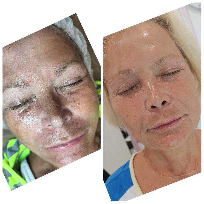 Опытный косметолог | Чистки, пилинги, инъекции