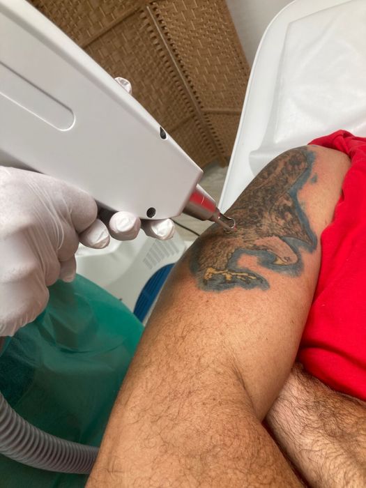 Depilacao a laser, remocao de tatuagem, peeling