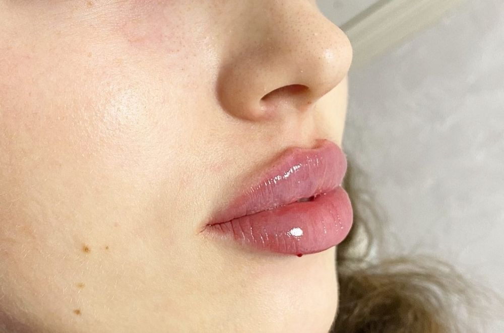 Пластика губ .Увеличение губ.Ботокс.