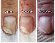 Máquina Laser Nd:YAG 980nm – Tratamento de Onicomicose (fungos unhas)