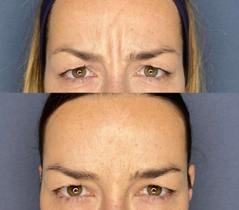 Ботулинотерапия! Гладкое личико! Ботокс!