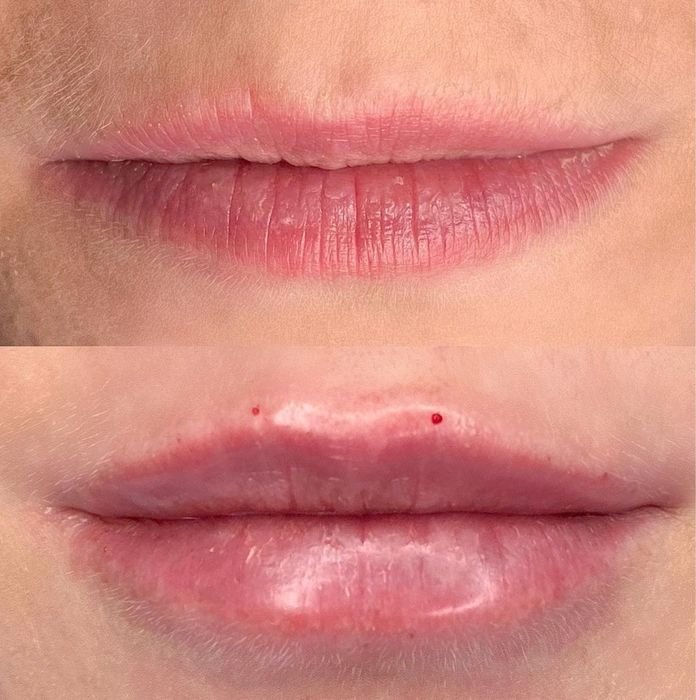 Косметолог. Увеличения Губ. Углы Джоли , скулы , Подбородок. Ботокс .