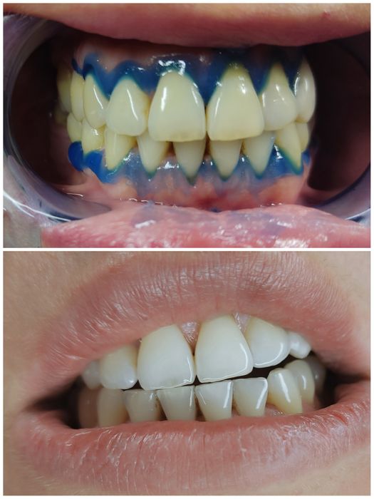 WYBIELANIE ZĘBÓW lampą LED – aż 38% żelu wybielającego! 
Promocja: tyl