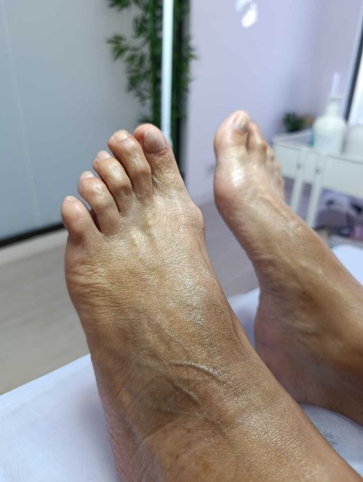 Tratamento fungos com laser