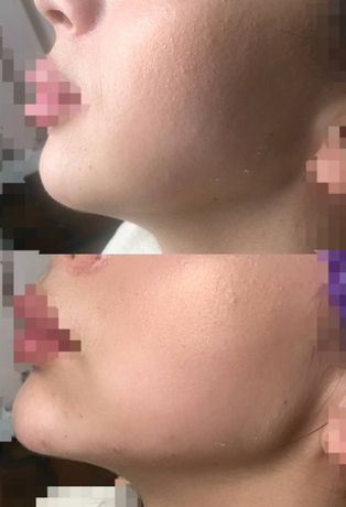 Увеличение губ.контурная пластика.врач-косметолог