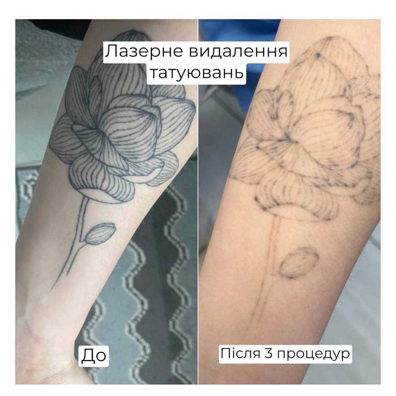 Лазерное удаление татуировок