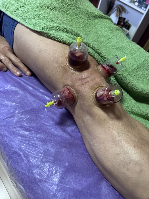 Ударно волновая экстракорпоральная радиальная терапия, аппарат 12 BAR