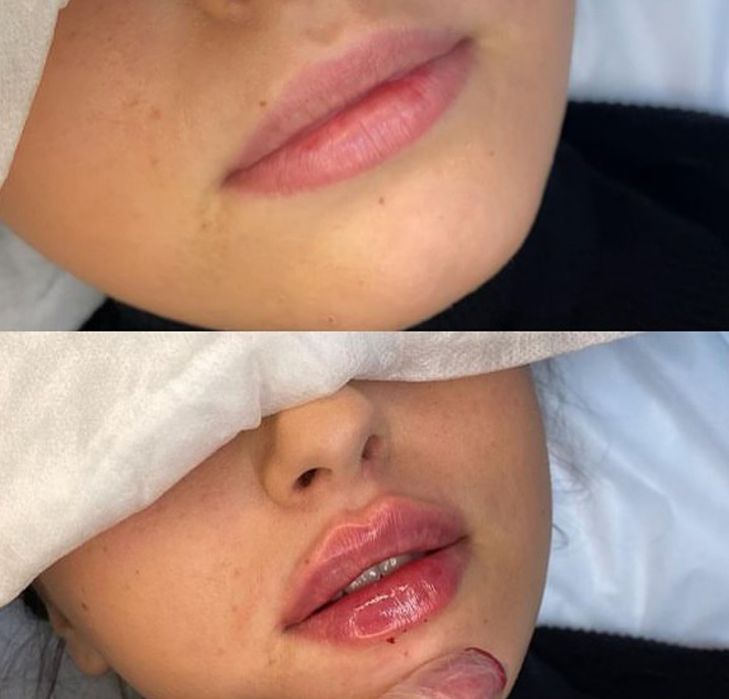 Косметолог- Дерматолог.Ботокс.Контурная пластика. Чистка лица. Массаж