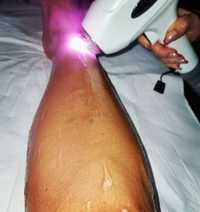 Equipamento depilação laser profissional