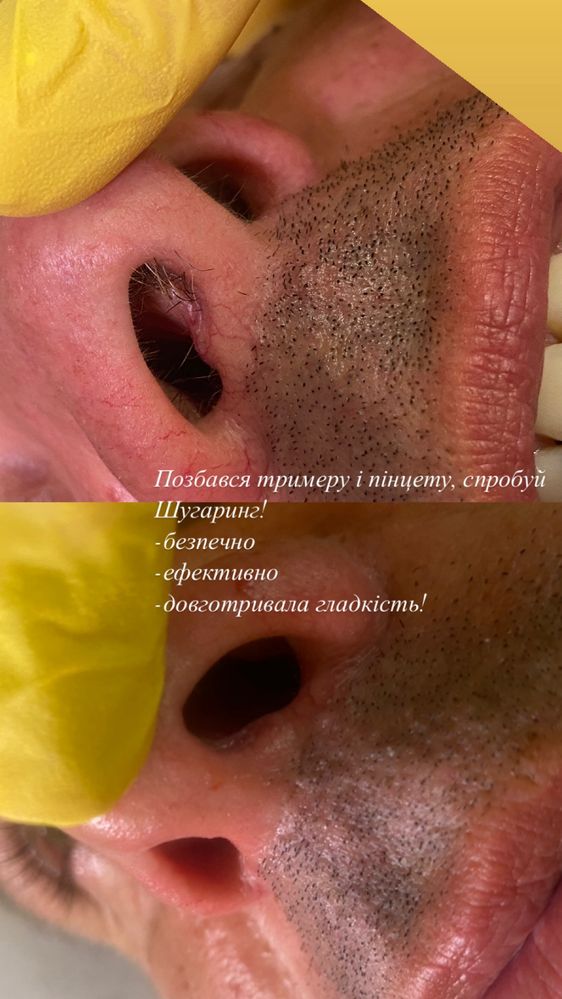 Чоловіча, жіноча депіляція, шугаринг, Миколаїв.