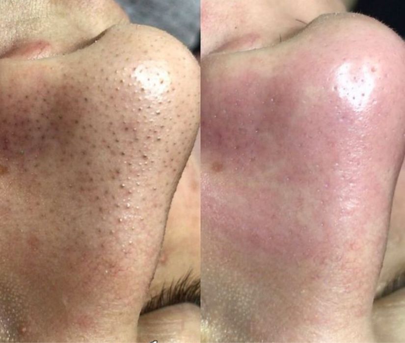 Косметолог. Увеличения Губ. Углы Джоли , скулы , Подбородок. Ботокс .