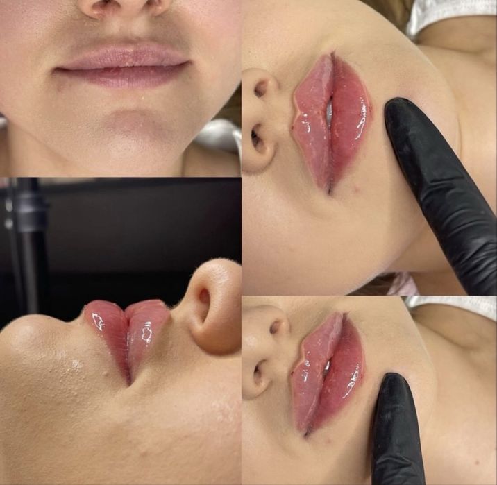 Увеличение губ, ботокс