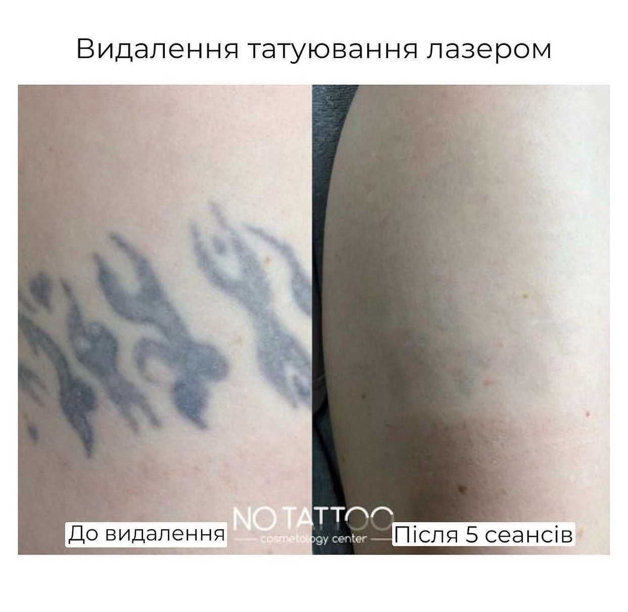 Лазерное удаление татуировок