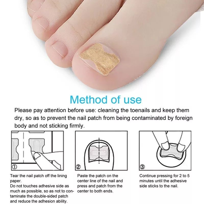 Наклейка Pexmen для коррекции вросших ногтей (набор 10 шт)