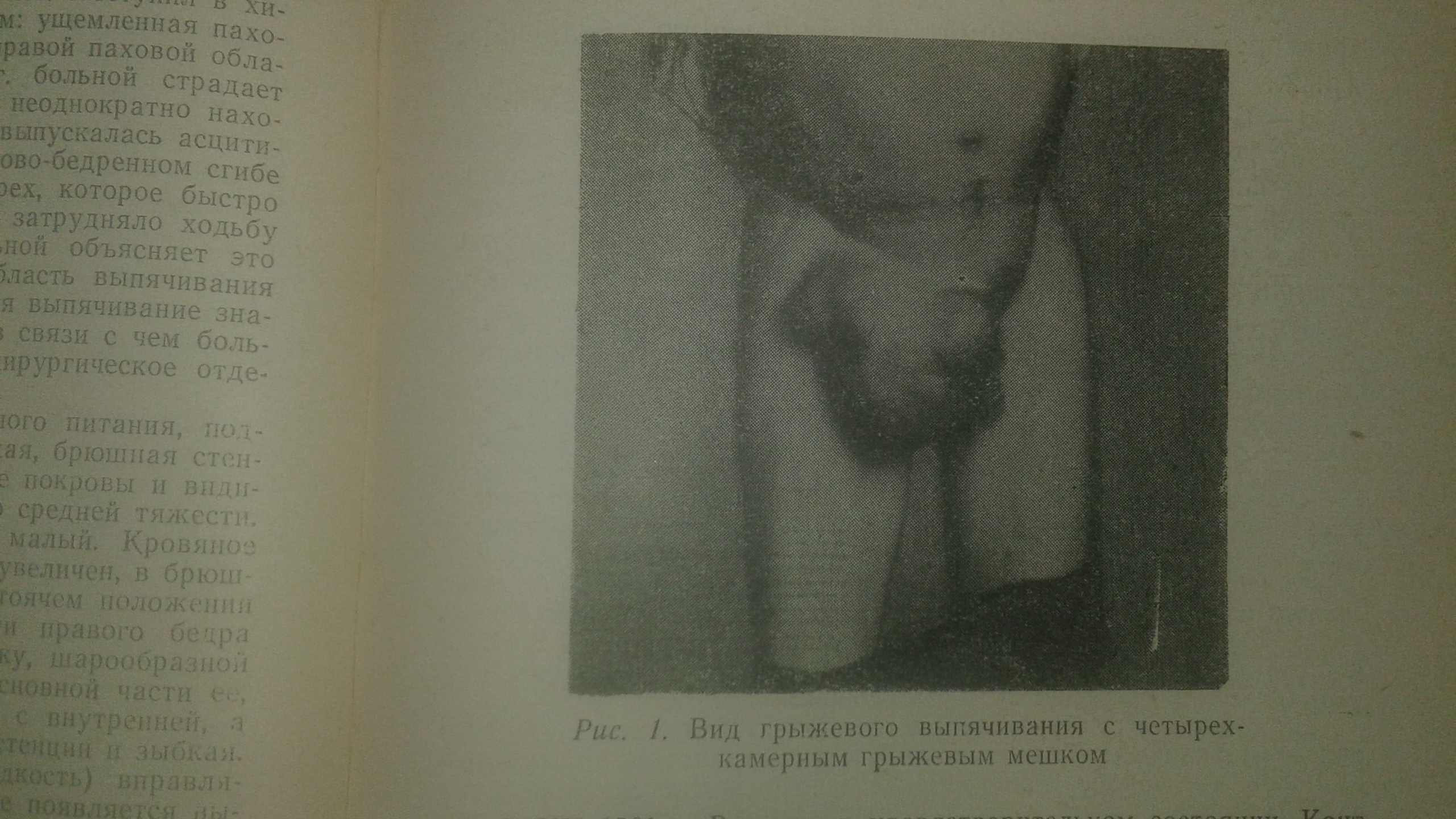 Хирургическое лечение бедренных грыж 1966 год