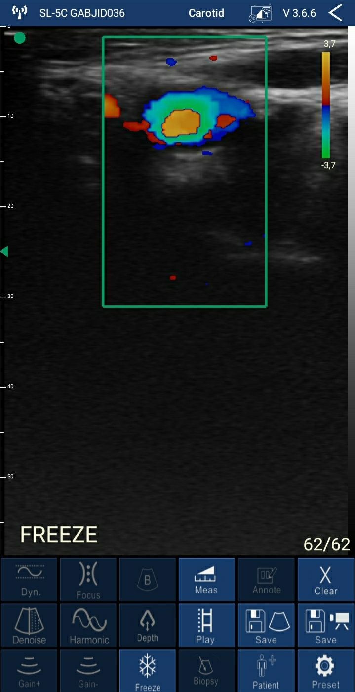 Ecógrafo: Sonda c/Doppler WiFi 5G (192 elementos ) + App