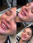Збільшення губ,косметологія,Botox,full face