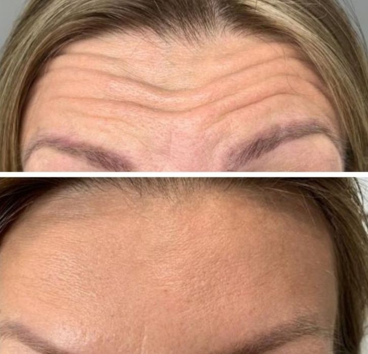 Promocja! Botox promocja 1 okolice 150zł do końca Grudnia