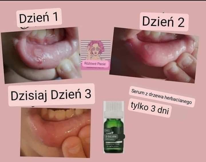 Sos serum  z drzewa herbacianego