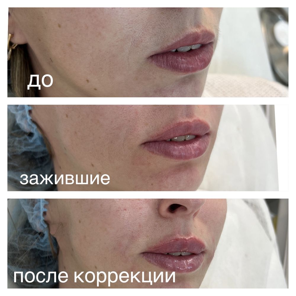 Увеличение губ врач дерматолог