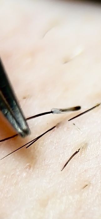 Електроепіляція, шугарінг, воск  - видалення волосся