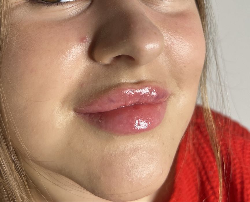 Збільшення обему губ