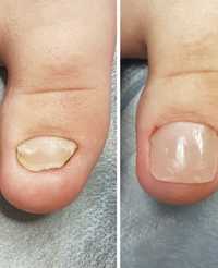 Протезування нігтів