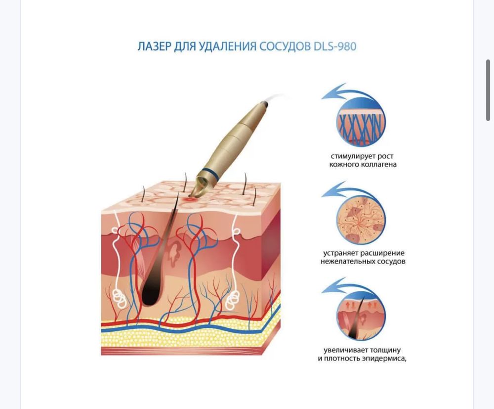 Лазер для видалення судин DLS 980