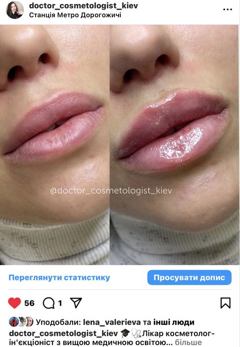 Лікар ботокс 1500грн губи 3000грн 1мл контурна пластика збільшення губ