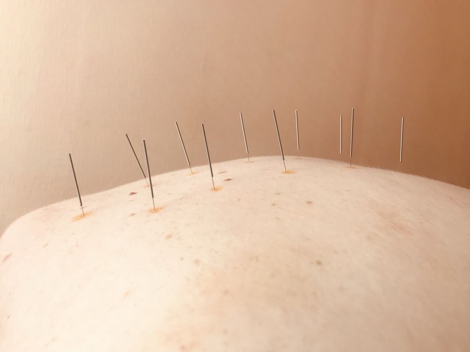 Масаж,реабілітація,мануальна вертебрологія,метод сухої голки м.Черкаси