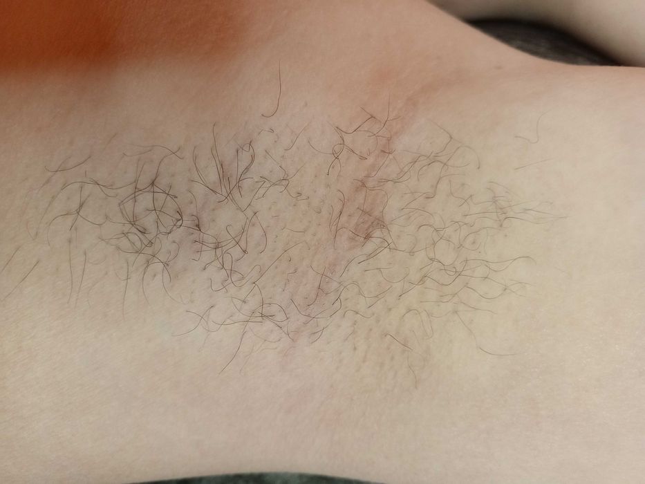 Воскова депіляція/Мікронідлінг/Мезотерапія/Вакуумно-роликовий масаж