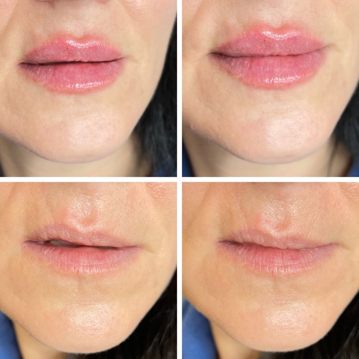 Губы от 2000грн, косметолог, ботокс,мезо-,био-, ТРК УКРАИНА