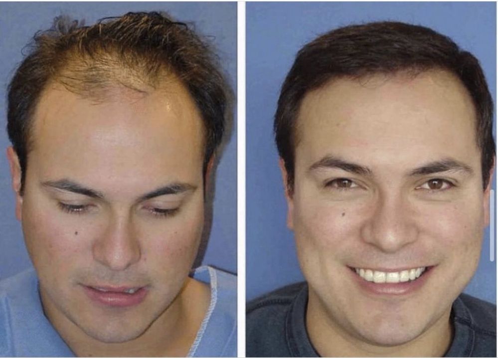 Minoxidil Extra forte -versão sem Álcool
