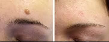 Косметолог-уход-массаж, удаление папиллом, бородавок, пигментных пятен