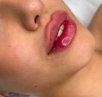 Powiększenie ust, stymulatory tkankowe, rewitalizacja skóry