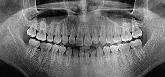 КТ зубов , панорамный снимок , рентген зуба , компьютерная томография