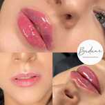Promocja! Powiększanie i modelowanie ust botoks botox lipoliza kwas hi