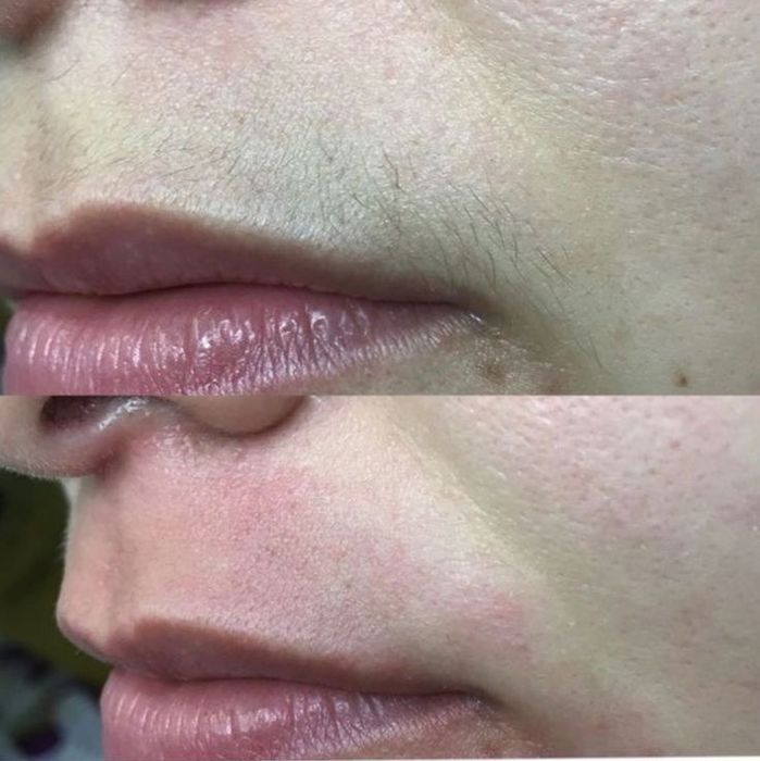 Шугаринг. Депіляція воском. Жіноча та чоловіча.  Дрогобич