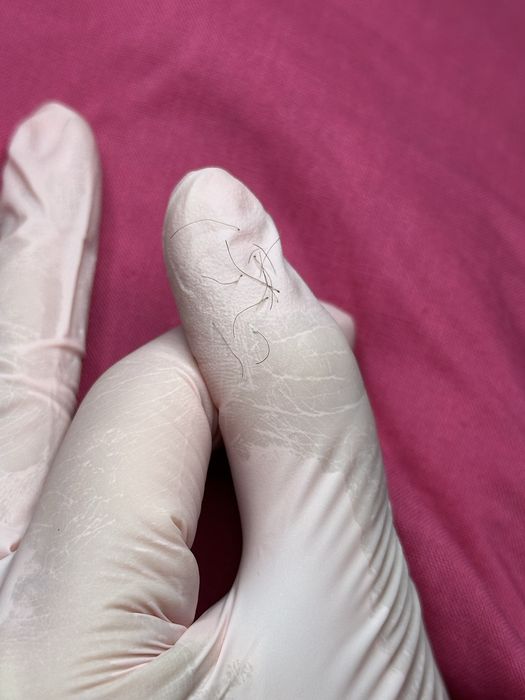 Електроепіляція Ірпінь