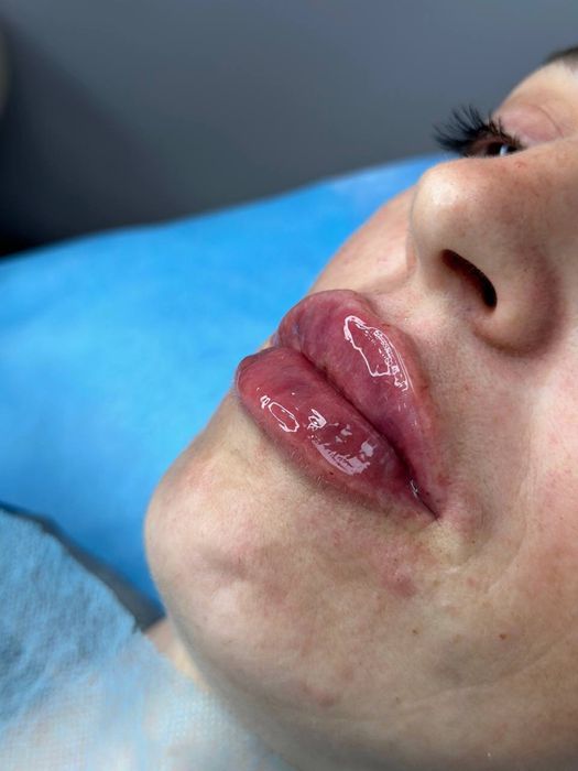 Увеличение губ , ботокс. Чистка лица