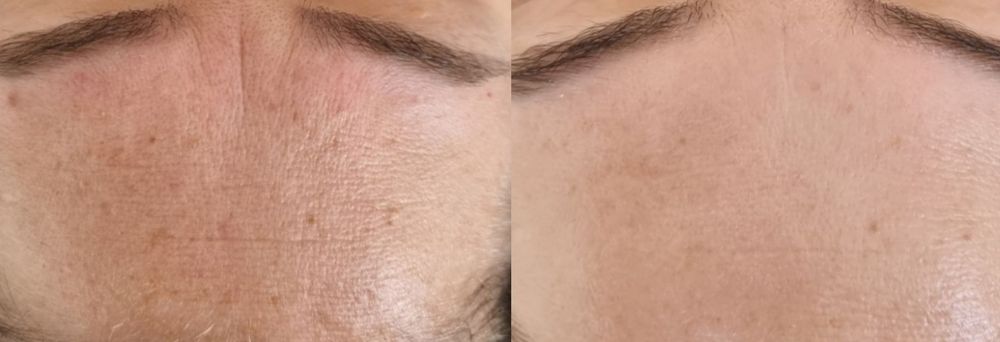 Косметолог з медичною освітою. Апаратний антицелюлітний масаж.