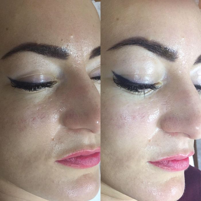 Косметолог Київ, Працюю!!  Акція Ботокс 2500 3 зони.